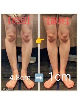 クシロ鍼灸整骨院/【O脚矯正】施術例