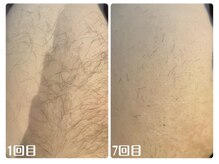 ルタンリッシュオム(Lutan Riche hom)/太もも脱毛 途中経過
