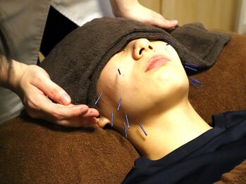 オータム(Autumn)/フェイシャル美容鍼[小顔]
