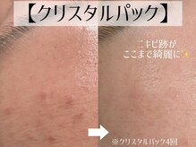 シュアショット(SURE SHOT)の雰囲気（繰り返す肌トラブル・悩みも肌質から改善＊ハーブピーリング）