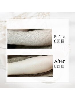 サロン ルイ(salonRui)/腕脱毛　before　afuta