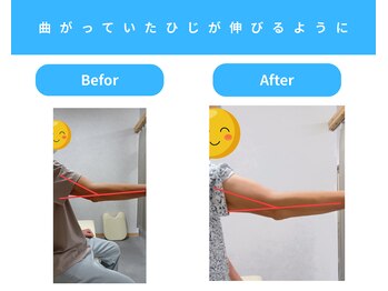 きくち整骨院/伸びない肘