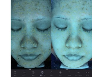 プレジール(Plaisir)/AI肌診断 施術前後の深いシミ