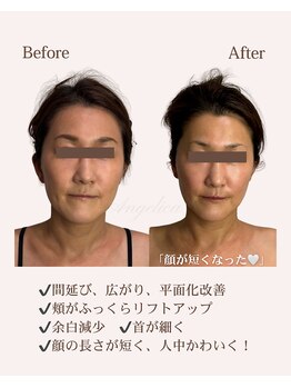 アンジェリカ(Angelica)/徹底たるみ改善！エイジングケア