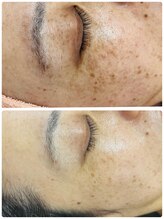 ナチュラルビューティラテ(NATURAL BEAUTY LATTE)/レチノールモニター