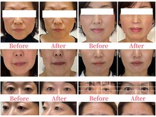 シルエラバレ(CiruelaValle)/Before After