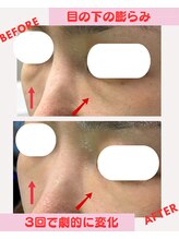 ユーフォリア(Euphoria)/目の下の膨らみもスッキリ！