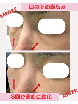 ユーフォリア(Euphoria)/目の下の膨らみもスッキリ!