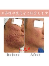 ハクビューティー(HAKU BEAUTY)/重いニキビ克服
