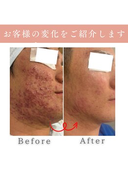ハクビューティー(HAKU BEAUTY)/重いニキビ克服