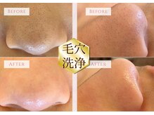 レフアの雰囲気(黒ずみもいちご鼻も改善する毛穴洗浄コースがすごい♪)