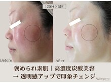 レガロビューティクリエイションズ桜川店/高濃度炭酸肌改善フェイシャル