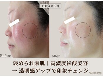 レガロビューティクリエイションズ桜川店/高濃度炭酸肌改善フェイシャル