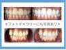 【お試し◇回数券】ホワイトニング4回+1回分ホワイトニングプレゼント(計5回)