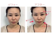 ブランフルレット 麻布十番/高周波温熱/小顔/むくみ