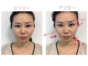 ブランフルレット 麻布十番/高周波温熱/小顔/むくみ