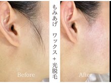 ミモザ(MIMOZA)/もみあげワックス＋光脱毛