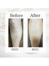 サロン ルイ(salonRui)/足脱毛　before　afuta