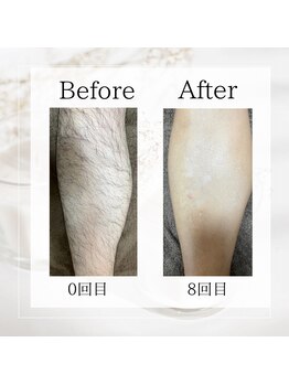 サロン ルイ(salonRui)/足脱毛　before　afuta