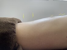 整体と鍼灸のセットメニューが人気♪