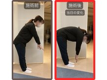 まこと整骨院/急なぎっくりな腰　当日の改善例