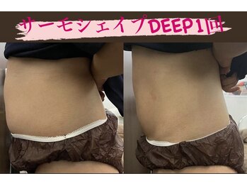 リラクゼーションサロン ラキ(laki)/サーモシェイプDEEP1回20代/痩身