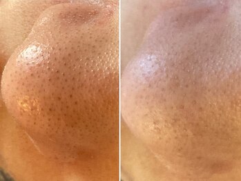 レスイズモア 恵比寿(less is more.)/一度の変化［ピーリングのみ］