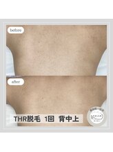 カラー(CALLA)/背中脱毛