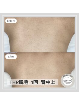 カラー(CALLA)/背中脱毛