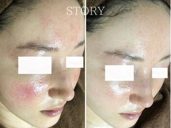 ストーリー 沼津店(STORY)/ハーブピーリング専門店STORY