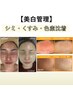 【美白肌管理】最高級美白ケア◎シミ・くすみ改善！