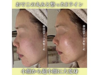 ハニエル(Haniel)/カーボキシー症例