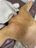 【剥離あり】本気の肌質改善ハーブピーリング(背中)