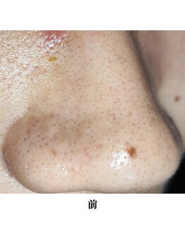 レイ(R.E.I)/詰まった毛穴