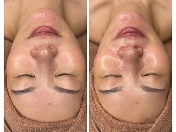 サロン ハリー(SALON HARRY)/韓国肌管理ララピールLHALA