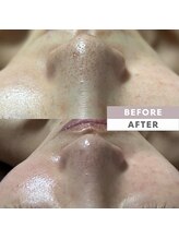 とぅるりん 肌質改善/気になる毛穴汚れにも♪