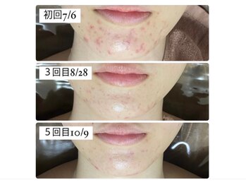 ホワイトアクア 広島店(WHITE AQUA)/ハーブピーリング/毛穴/小顔