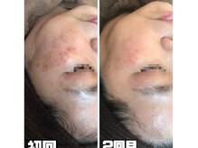 ヴィノ アイサロン(VINNO eyesalon)/高濃度美容液併用で◎