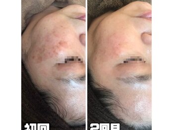 ヴィノ アイサロン(VINNO eyesalon)/高濃度美容液併用で◎