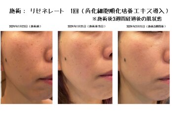 ムーア(muua)/毛穴洗浄×リゼネレート(幹細胞)