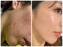 アリュール 京都烏丸御池店(ALLURE)の雰囲気（ダウンタイムなしで速攻性抜群ハーブピーリング◎ニキビケアにも）