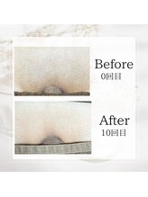 サロン ルイ(salonRui)/VIO脱毛　before　afuta