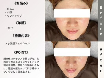 ルディラ 恵比寿店/水光肌フェイシャル