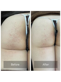 ハーブピーリング【背中 ニキビ 毛穴ケア】EMILUCA 天王寺店 /お尻もツルツルに