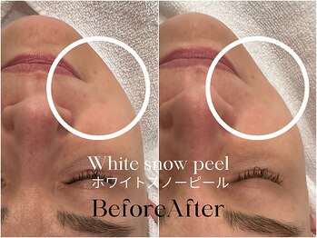 トウキョウビューティーラボ(TOKYO BEAUTY LABO.)/スノーピールBefore&After