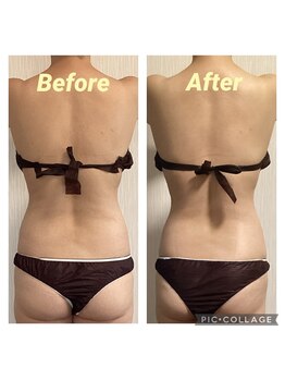 エソール(essor)の写真/短期集中ダイエット◎凸凹セル脂肪撃退☆最新痩身機器ラジオ波WINBACKで理想の美ボディ♪サイズダウン叶う