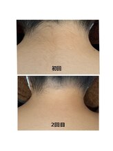 ジェシカ 荻窪店/荻窪/うなじ脱毛☆