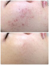 アンジェロ/【ニキビケア】肌育プログラム