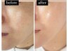 赤ちゃん肌へ導く新感覚ピーリング　BABY PEEL  6,000円→5,000円