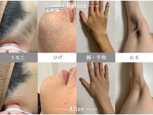 アマリリス(Amaryllis)/脱毛 before/after